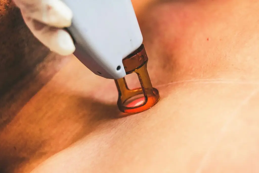 vergeture au laser avant apres