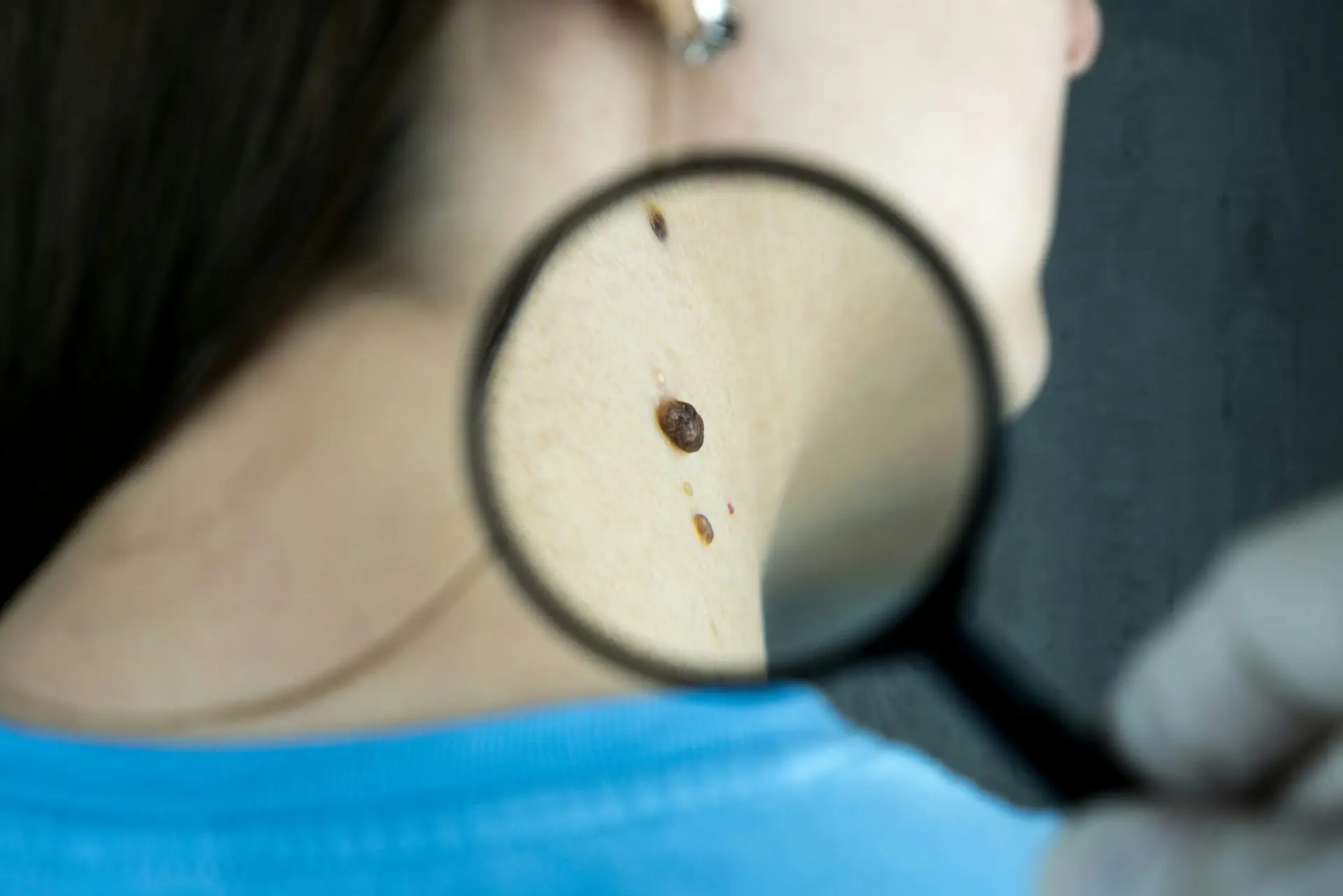 comment enlever un grain de beauté sans chirurgie