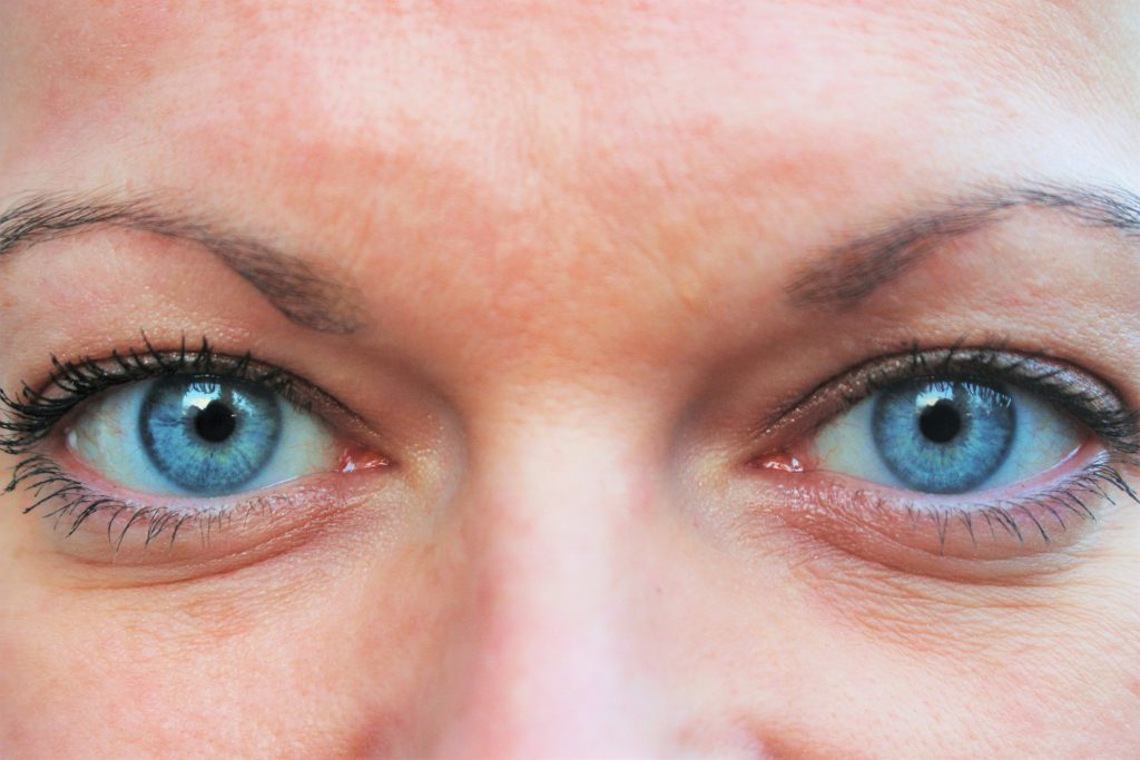 rides sous les yeux médecine esthétique