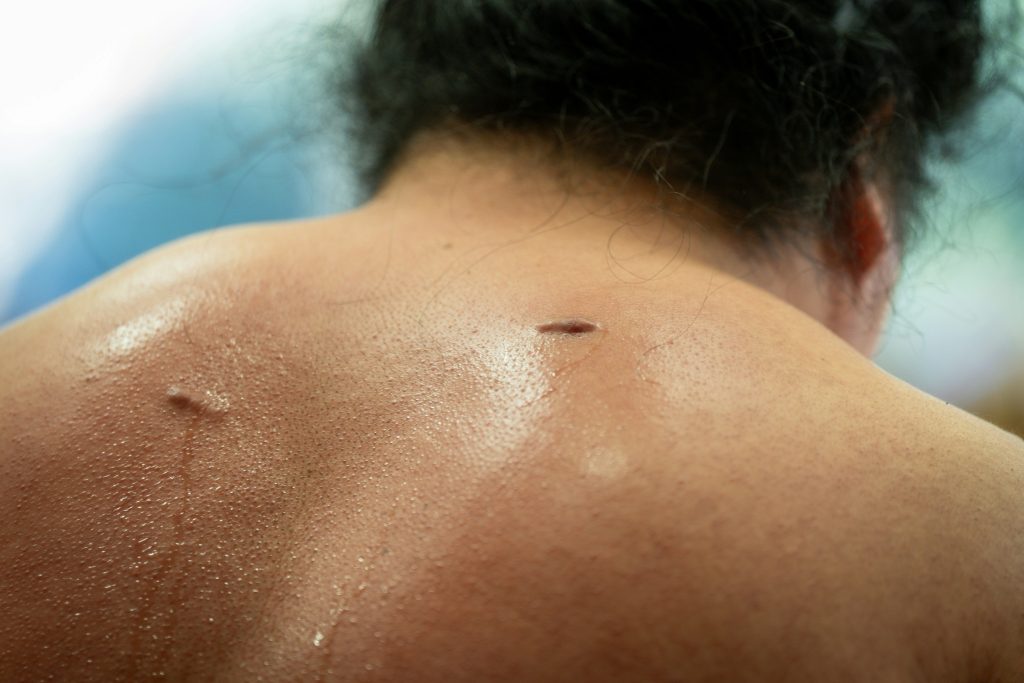 enlever un grain de beauté sans chirurgie​
